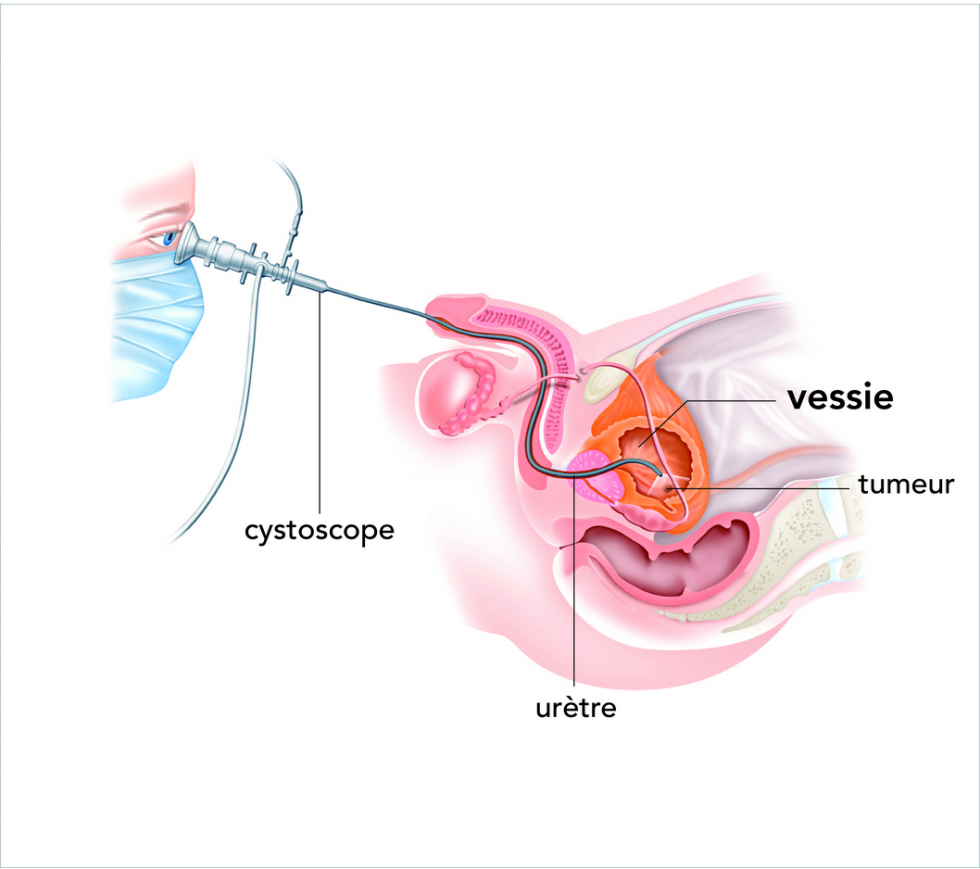 Cystoscopie chez l'homme www.e-cancer.fr/Patients-et-proches/Les-cancers/Cancer-de-la-vessie/Le-diagnostic