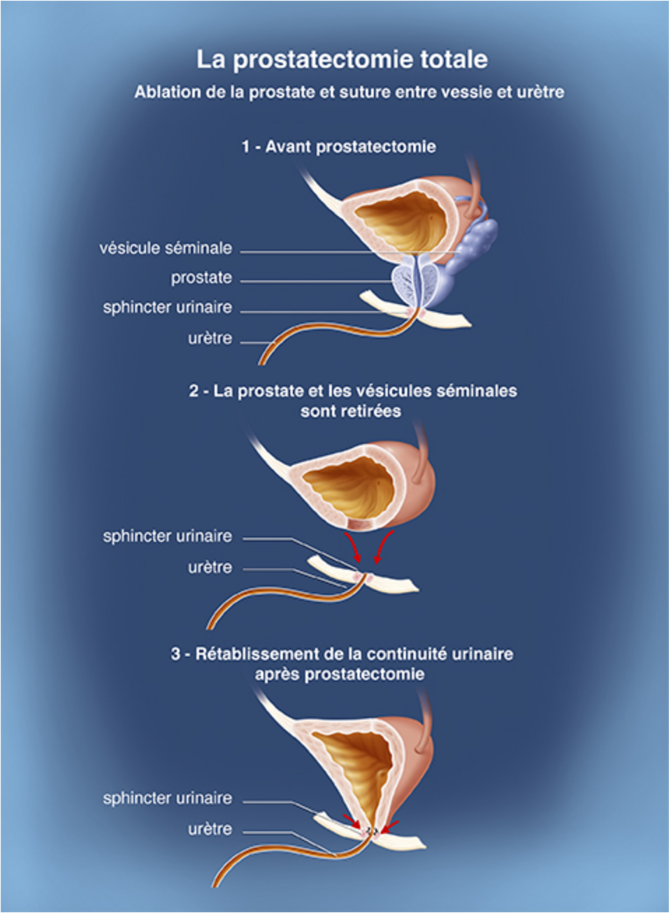 Schéma prostatectomie radicale. Source: e-cancer.