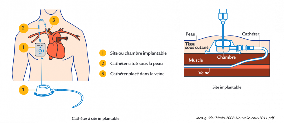 Schéma site veineux implantable