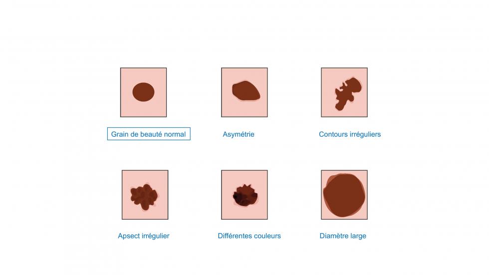 diagnostic ABCDE dans le cas d'un mélanome