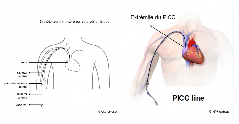 Schéma d'un PICC-Line