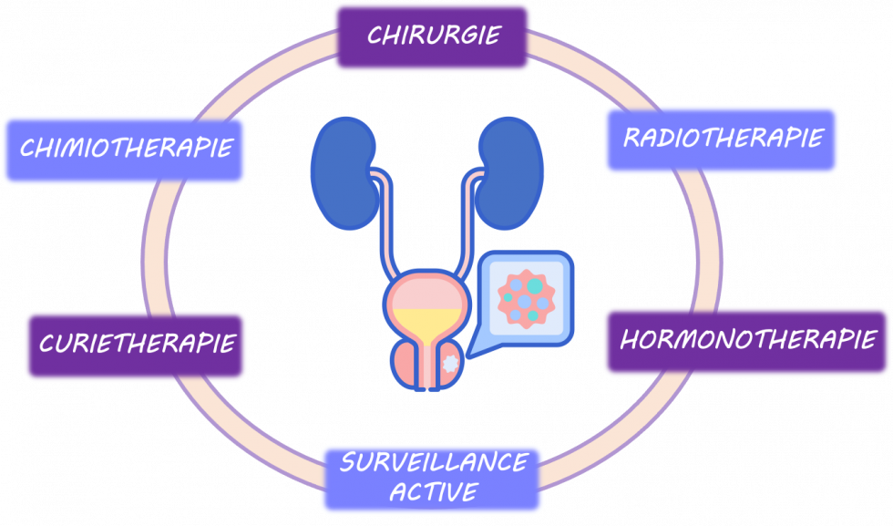 Présentation des différents traitements dans le cancer de la prostate