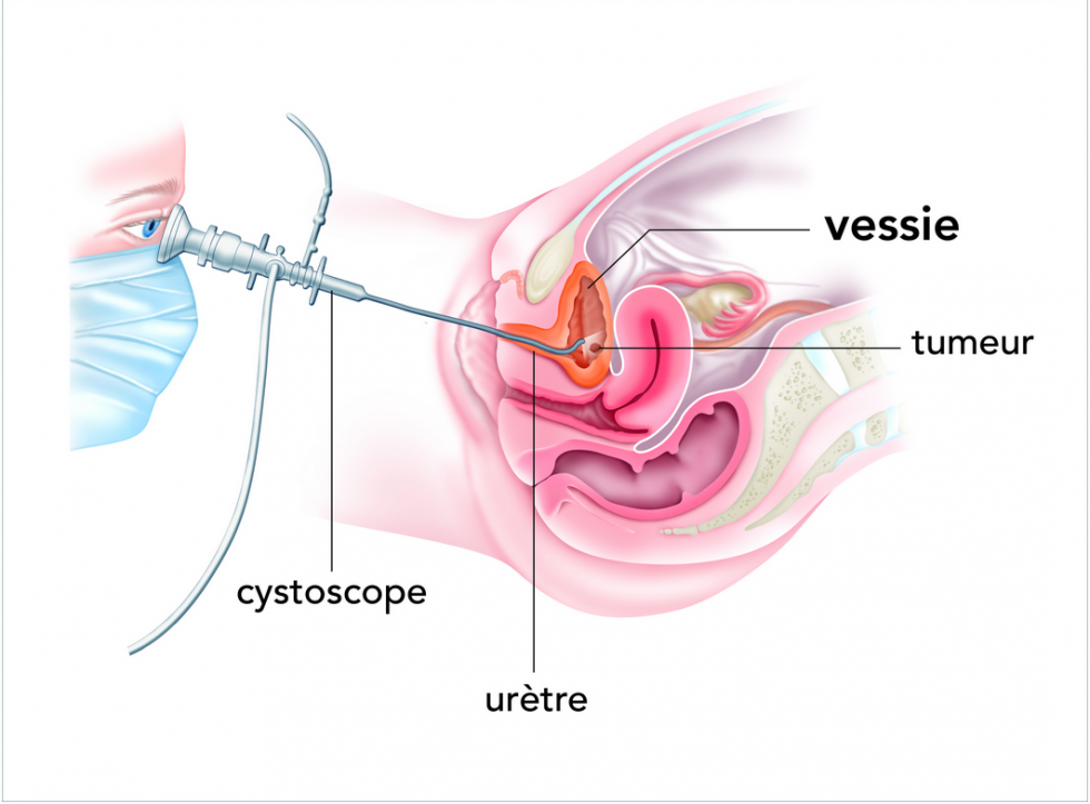 Cystoscopie chez la femme www.e-cancer.fr/Patients-et-proches/Les-cancers/Cancer-de-la-vessie/Le-diagnostic